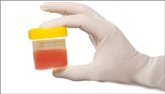 Blood in the urine (haematuria)